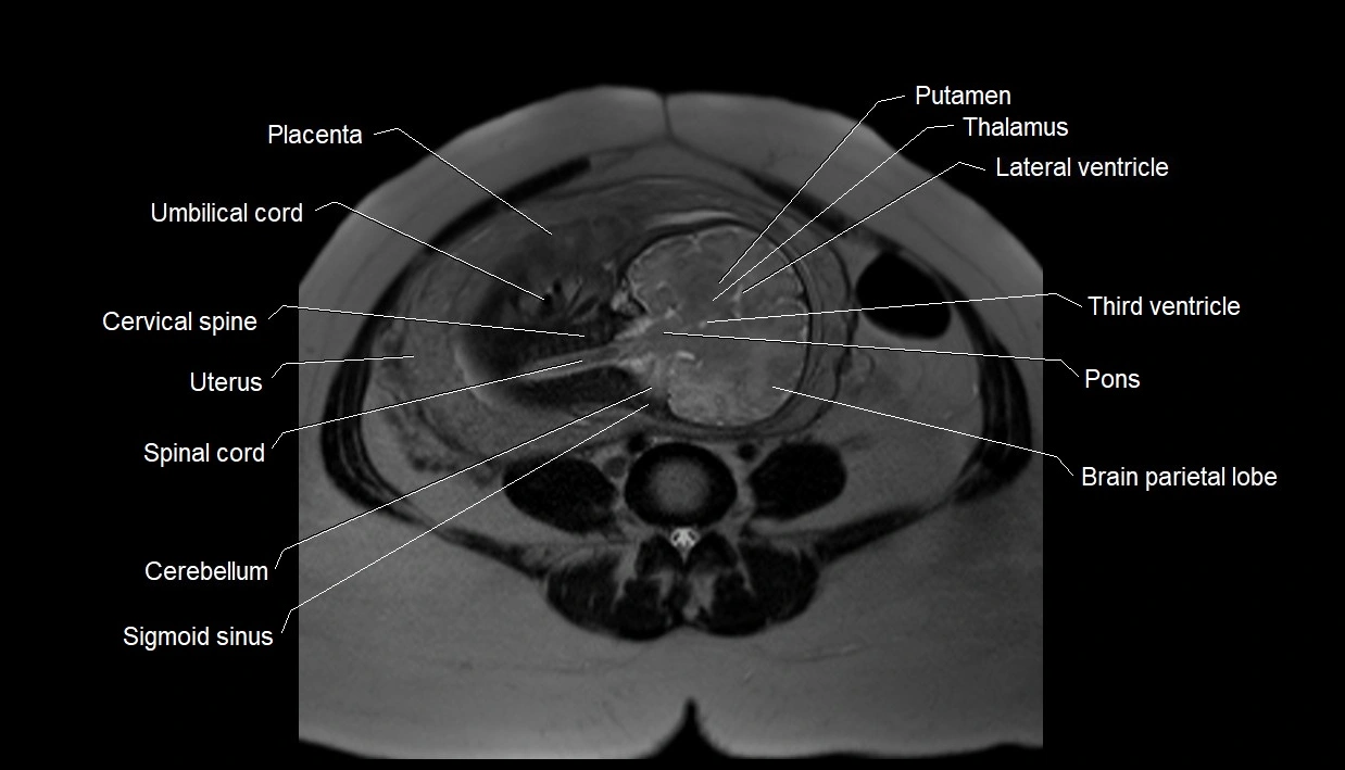 MRI fetal anatomy axial image 21.webp